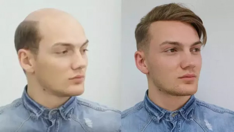 What Happens if You Go Through an FUE Hair Transplant Very Early?