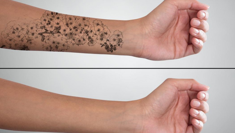 Tattoo Removal Market Report Available on Introspective Market Research 2022