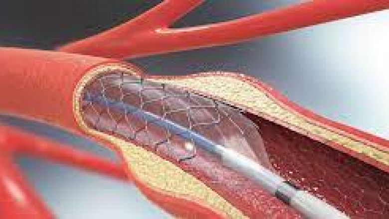 Cardiovascular Stents Market to Witness Notable Growth by 2027