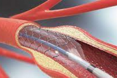 Cardiovascular Stents Market to Witness Notable Growth by 2027