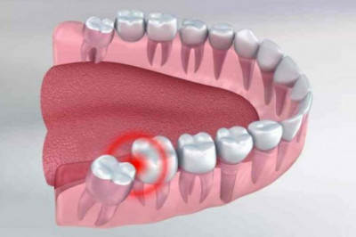 What are the Multiple Stages of Periodontal Disease?