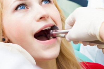 5 Reasons To Go For Tooth Extraction