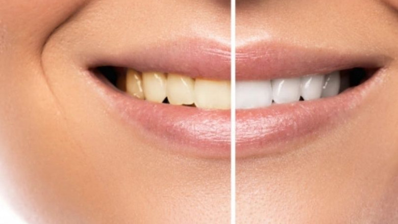 Four Things You Must Know Before Teeth Whitening