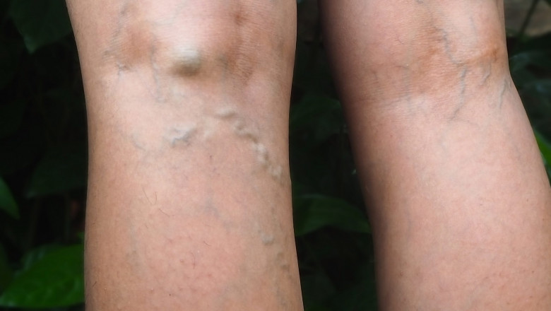 What Are The Facts You Should Know About Varicose Vein Laser Treatment?
