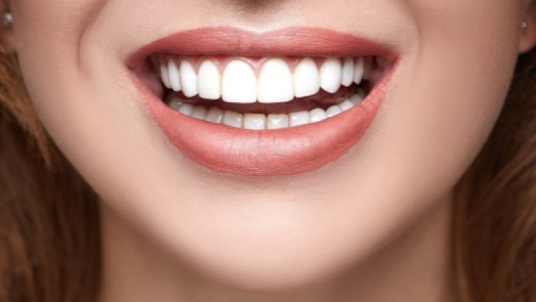 Teeth Whitening Waterloo