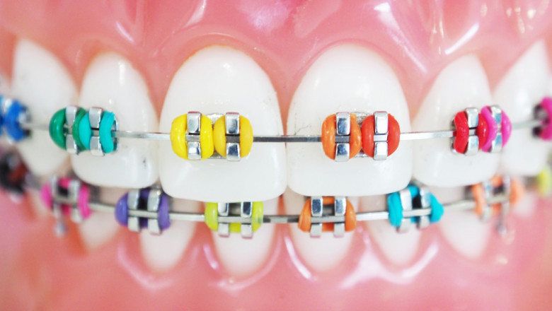 What Are The Braces Options For Teens?