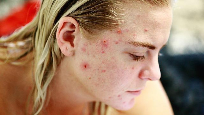 Actinic Keratosis Market - Global Industry Insights, Trends, Outlook, and Opportunity Analysis, 2018 – 2026