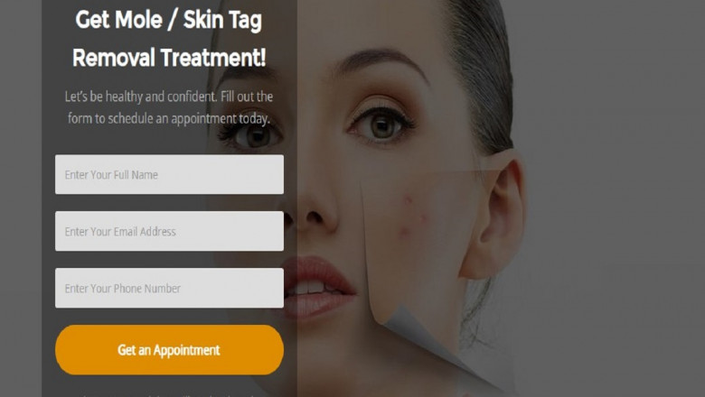 Skin Tag Removal Near Me launches its new website