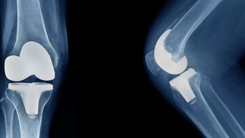 TOP 9 FAQ Related to knee replacement surgery