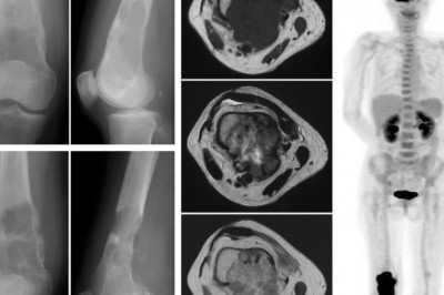 Angiosarcomas treatment market remedies