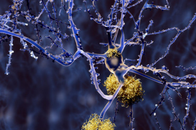 Tips for managing everyday life in Alzheimer's Disease |webhealth