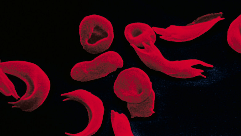 Global Hemoglobinopathy Market Size, Share & Trends Analysis Report and Forecasts, 2019-2027