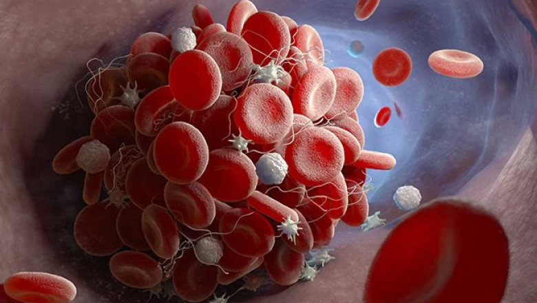 Prevention and Strategies for Calciphylaxis Treatment
