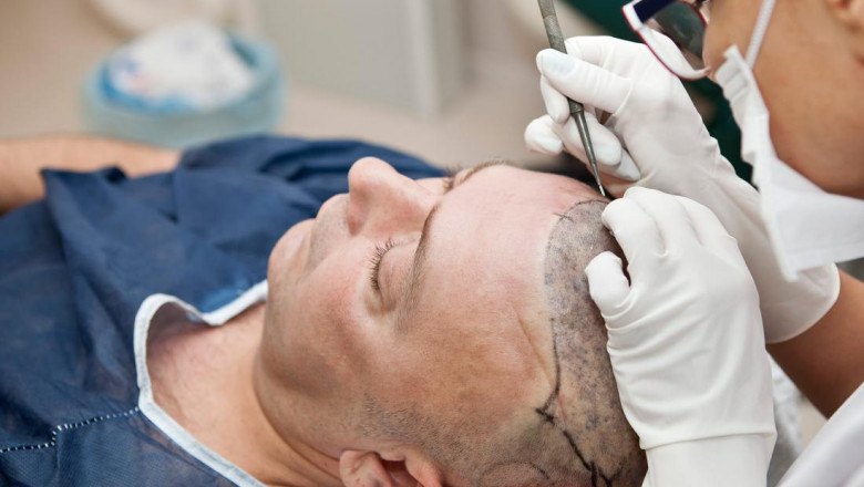 Things to know about - Laser Hair Removal