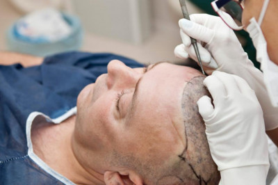 Things to know about - Laser Hair Removal