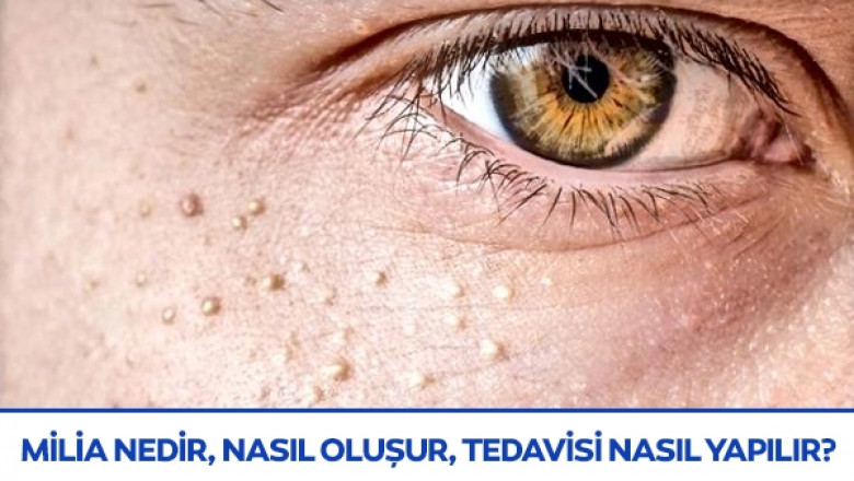 Milia Neden Olur