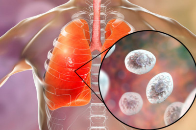 Acute Invasive Aspergillosis Treatment involves the consumption of antifungal drugs and the surgical removal of infected tissues