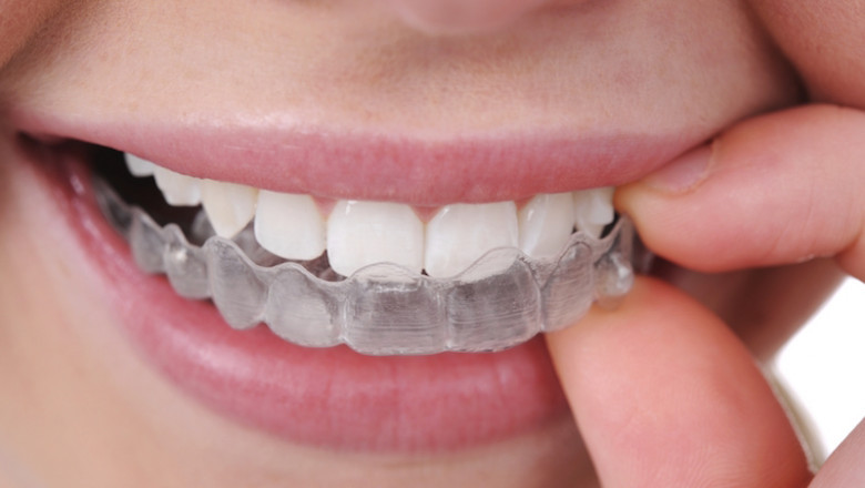 How Do Invisible Braces Work?