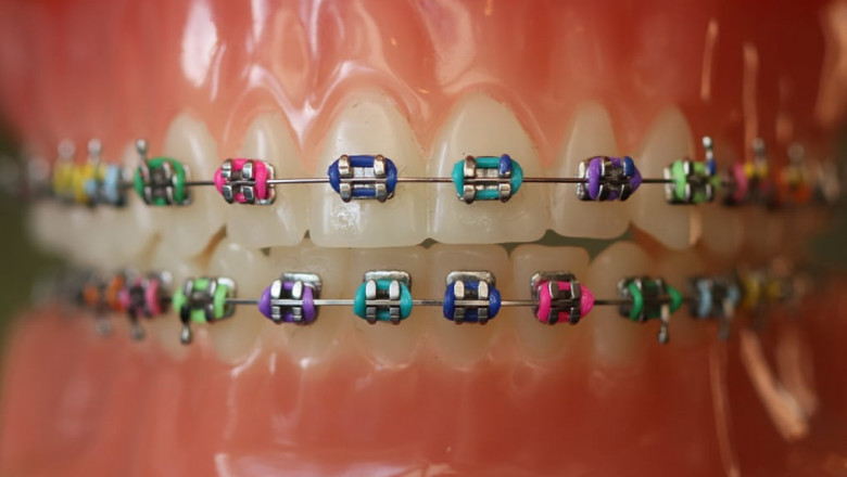 How To Choose The Best Suitable Braces For Your Teeth?