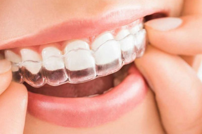 Top Benefits of Using Invisalign Over Traditional Braces