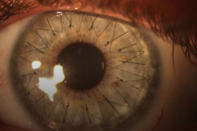 All About Cornea Surgery