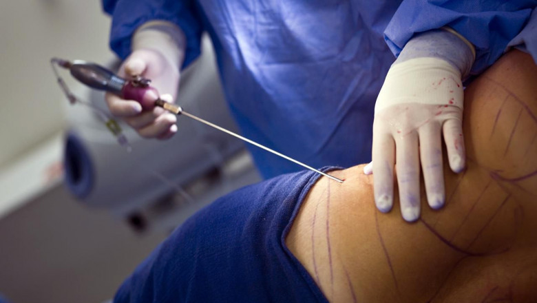 Everything to Know about Liposuction