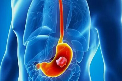 Paracentesis is the most common method in malignant ascites treatment