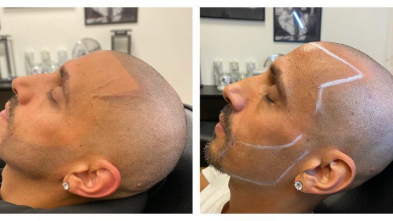 Common Instances Where People Need Hair Pigmentation