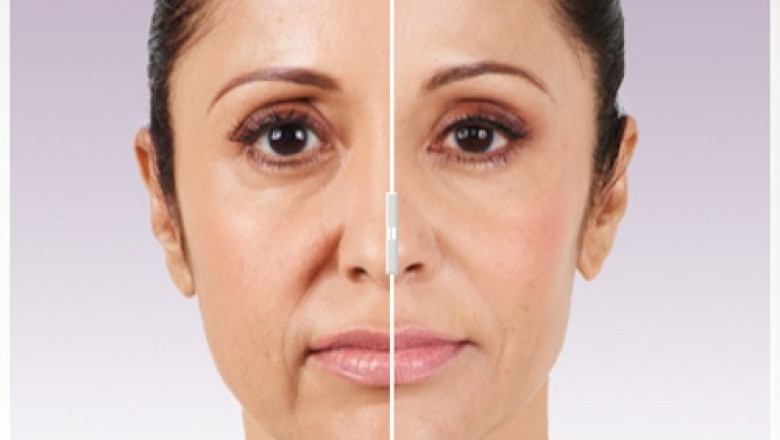 Dermal Fillers Market - Global Industry Growth and Forecast – 2027