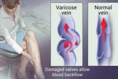 Best Varicose Veins Treatment | Venocare Dubai