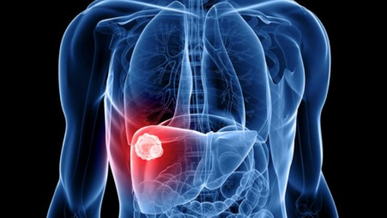 Global Liver Cancer Diagnostics Market Analysis by 2022-2028|Abbott Laboratories (US),Becton Dickinson and Company (US),F. Hoffmann-La Roche Ltd (Switzerland)