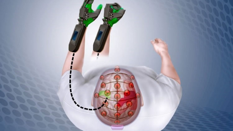 Global Neuroprosthetics Market 2022 Expeditious Growth, Opportunities and forecast to 2027