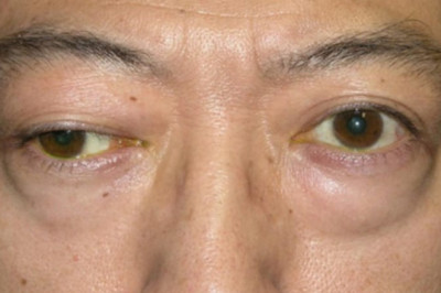 Myasthenia Gravis Market: Industry Analysis, Opportunity and Forecast to 2027