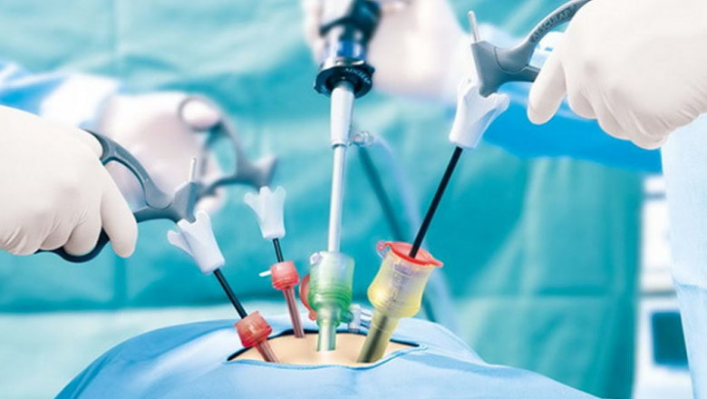 Global Minimally Invasive Surgery Market Size, Share, Trends, Industry Growth, Forecast 2022 to 2028
