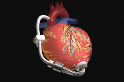 What are the symptoms of Dilated Cardiomyopathy?