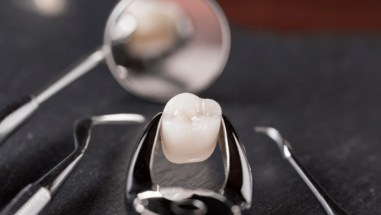What Is A Root Canal Treatment?