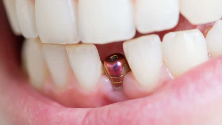 What Types of Filling Materials Are Available?