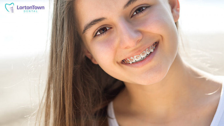 Your Basic Guide to Invisalign