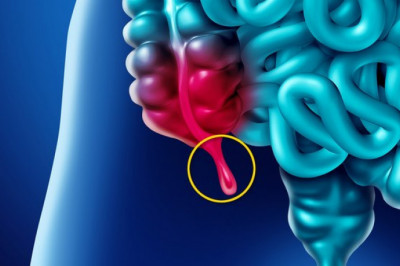 Appendiceal Cancer Treatment Market: Industry Analysis, Opportunity and Forecast to 2027