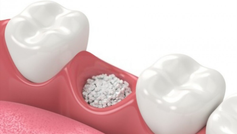Benefits of Bone Grafting and Things You Need To Know