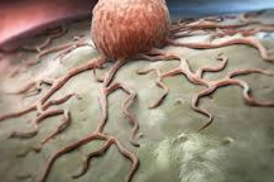 Desmoid Tumors Market - Global Industry Analysis by Size, Share and Forecast 2022 – 2027