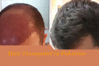 After Hair Surgery Necessary to Follow Surgeon Guidance