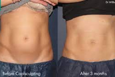 Body Contouring Market 2022 – Global Industry Market Report 2027