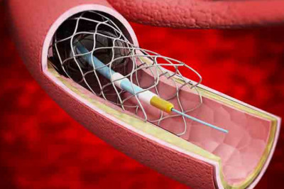 Cerebral Vascular Stent Market 2022: Size, Share, Analysis and Forecast-2027
