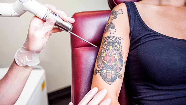 Permanent Laser Tattoo Removal Treatment