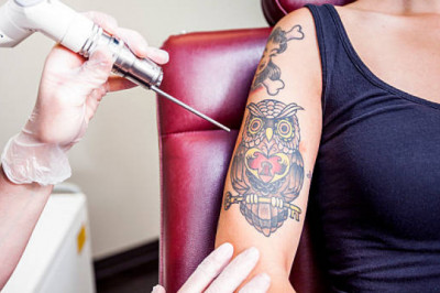 Permanent Laser Tattoo Removal Treatment