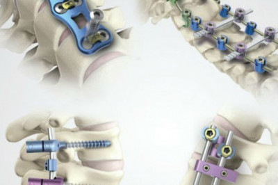 Spinal Implants Market Share: Industry Analysis, Opportunity and Forecast to 2027