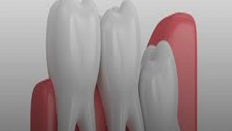 What to Ask a Cosmetic Dentist Before Teeth Whitening?