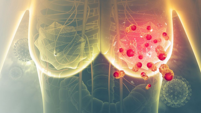 How can you know if you have early Breast Cancer Diagnostic?