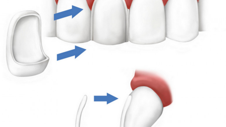 What is Laser Dentistry and What to Expect from it?